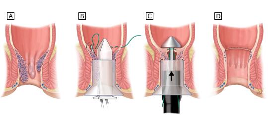 Stapled Hemorrhoidectomy